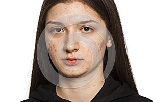 Teenage girl with problematic skin