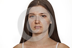 Teenage girl with problematic skin