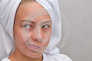 A teenage girl twisted her face, which she does not like because of acne. Acne