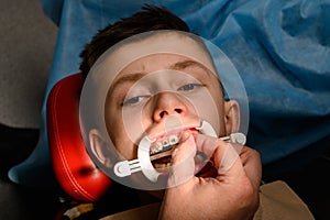 The teenager has braces glued to his upper teeth to straighten them, and the boy has a retractor on his lips.