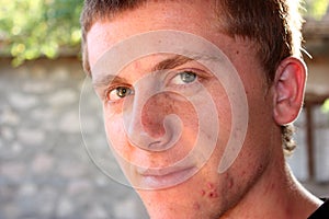 Teenager with pimples on his face