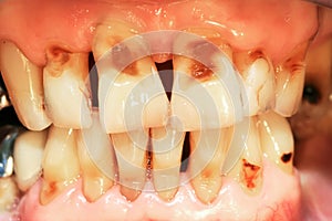 Teeth abrasion photo
