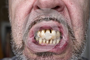 Teeth affected by periodontitis