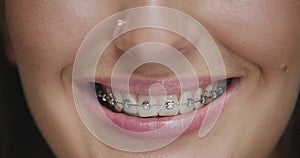 Teeth alignment by braces. Close up of female friendly smile. Dental care, orthodontic treatment. Correction of overbite