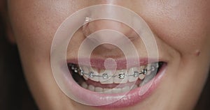 Teeth alignment by braces. Close up young woman licks lips seductively with tongue. Dental care, orthodontic treatment