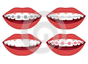 teeth alignment. Metal, ceramic, plastic, ligature and invisible braces photo