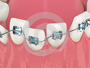 Teeth alignment by orthodontic braces isolated over white background