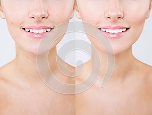 Before and after teeth bleaching or whitening treatment. Close-up of young Caucasian female`s smile. Natural make-