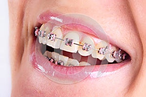 Teeth with braces