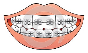 Teeth with braces