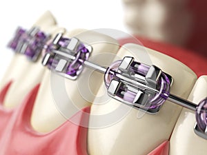Teeth with braces or brackets in open human mouth. Dental care