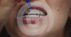 Teeth, braces brushing. Close up female cleaning interdental by orthodontic toothbrush. Dental hygiene, dentistry