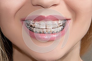 Teeth with braces
