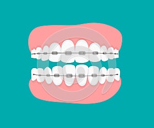 Teeth with braces.Flat vector illustration. Jaws isolated. orthodontic treatment braces on teeth. Dentistry and Orthodontics