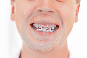 Teeth with braces. Isolated