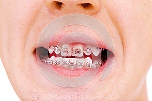 Teeth with braces. Isolated