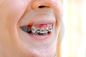 Teeth with braces. Isolated