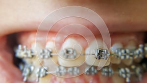 Teeth with braces or braces in an open human mouth. Selective focus on one bracket. Dental care. Straightened teeth photo
