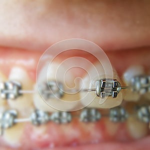 Teeth with braces or braces in an open human mouth. Selective focus on one bracket. Dental care. Straightened teeth photo