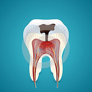 Teeth caries in cutaway