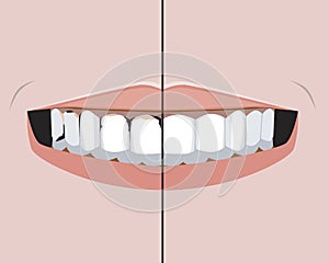A teeth with caries and pulpitis and a healthy smile as a treatment concept in a dental or orthodontic clinic, a vector stock