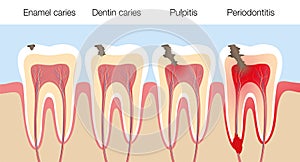 Teeth Caries Stages Pulpitis Periodontitis Enamel Caries