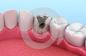 Teeth with caries, treatment. Medically accurate tooth illustration