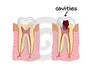Teeth cavities