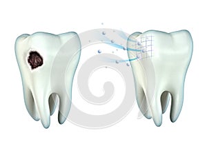 Teeth cavity