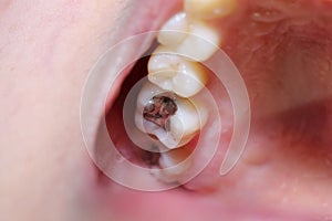 Teeth cavity with the treatment photo