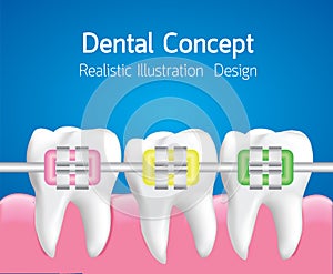 Teeth with Colourful braces, Dental care concept, Realistic Vector