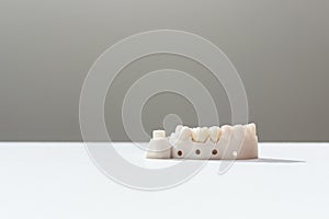 Teeth Crowns And Bridge Equipment Model Shows Fix Restoration, Prosthodontics Or