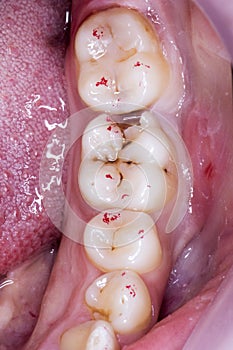 Teeth decay