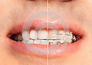 Teeth with and without dental braces full mouth photo