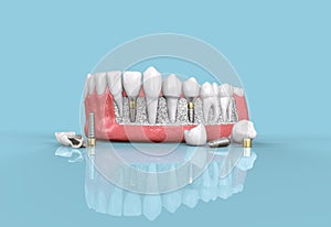 teeth dental implant model 3d illustration