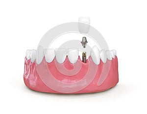 Teeth dental implant model 3d illustration