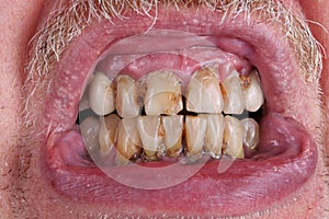 The teeth of an elderly man are spoiled by caries, tartar and po