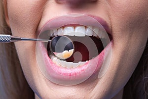 Teeth examined at dentists. Healthy woman teeth and a dentist mouth mirror. Ideal teeth. Dental tools. Close up womans