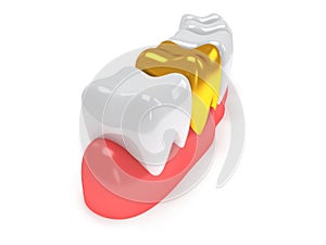 Teeth on gingiva isolated on white back.