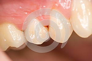 Teeth and gingivitis