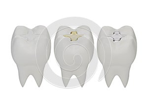 Teeth with gold, amalgam and composite inlay dental filling