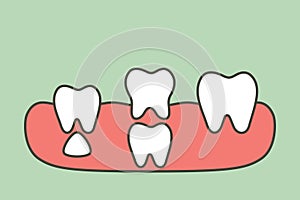 teeth are growing up from the gum by permanent tooth located below primary tooth, first tooth - dental cartoon vector flat style