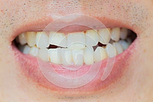 Teeth Injuries or Teeth Breaking in Male. Trauma and Nerve Damage of injured tooth