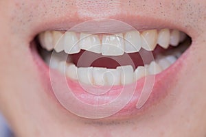 Teeth Injuries or Teeth Breaking in Male. Trauma and Nerve Damage of injured tooth