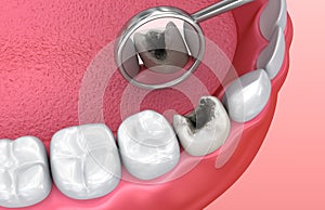 Teeth inspection with mirror. Medically accurate tooth 3D illustration