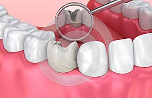 Teeth inspection with mirror. Medically accurate tooth illustration