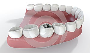 Teeth With Lead Filling