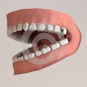 Teeth with lead fillings