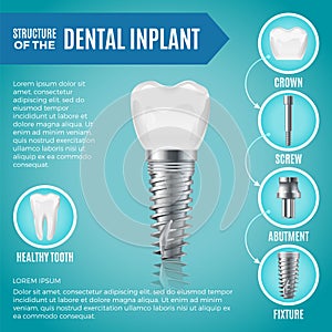 Teeth maquette. Structural elements of dental implant. Infographic for medicine poster