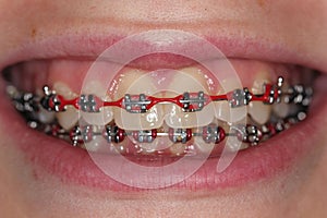 Teen With Red Metal Braces Orthodontics Brackets photo